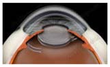 IOL Intraocular Lens Implant Treatment Bangalore India, Cataract Surgery, Cataract Surgeon, Restor, Crystalens